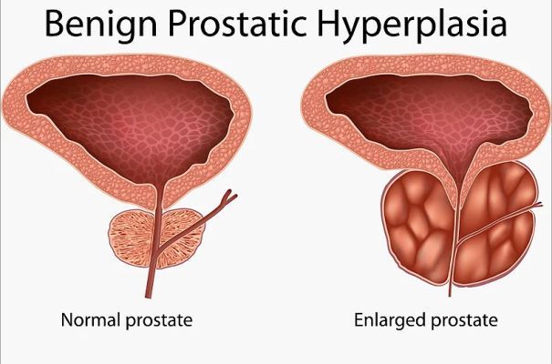 prostate treatment in Pitampura